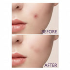 ClearSkin Pro – 3-in-1 Microneedle Bundle